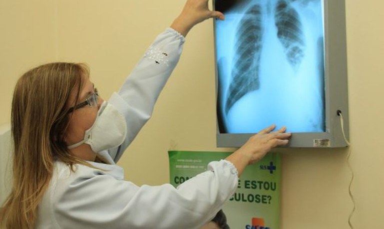 Medicamento que possibilita tratamento encurtado para tuberculose está em consulta pública até 4 de setembro