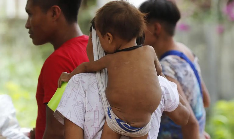 Ações do Ministério da Saúde recuperaram 307 crianças Yanomami diagnosticadas com desnutrição