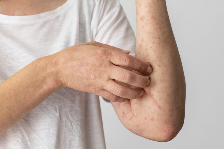 No Dia Mundial da Alergia, a Rede Ebserh chama atenção para o subdiagnóstico